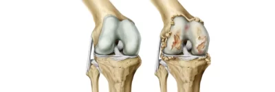 Read more about the article Osteoartrit – Kireçlenme